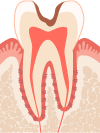 C2.虫歯によって象牙質まで穴が開いてしまった状態