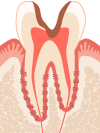 C3.歯髄まで浸食され、大きな穴が開いた状態