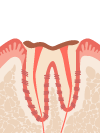 C4.歯肉から歯冠がほとんどなくなり、歯根だけ残っている状態