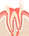 虫歯部分を除去し、歯冠から歯髄腔まで穴をあけます