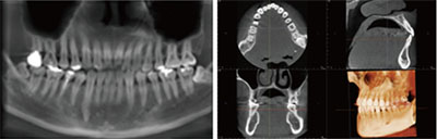 患者様の被ばく線量を抑えた歯科用CT　KaVo 3D eXam I